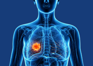 Bild von Entitätenspezifische Qualitätskonferenz zum Mammakarzinom